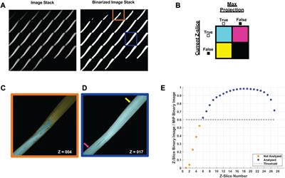 Detyrosinated microtubule arrays drive myofibrillar malformations in mdx muscle fibers
